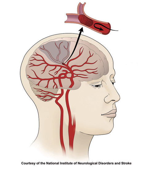 Diagram of the brain with a close-up of blocked blood flow